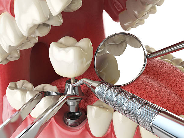 Best Emergency Tooth Extraction in Reno, NV